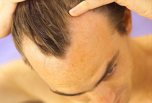 Kas izraisa matu izkrišanu?