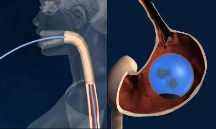 Operācijas procedūra, lai samazinātu kuņģi, kā un kāpēc tas tiek darīts. Kuņģa zondēšana