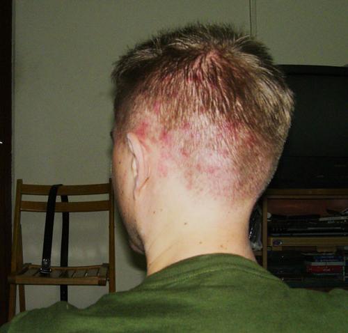 Acne uz galvas zem matiem: ārstēšanas izskata iemesli un īpašības