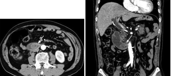 Izgatavotās cilpas sindroms: diagnostika un ārstēšana